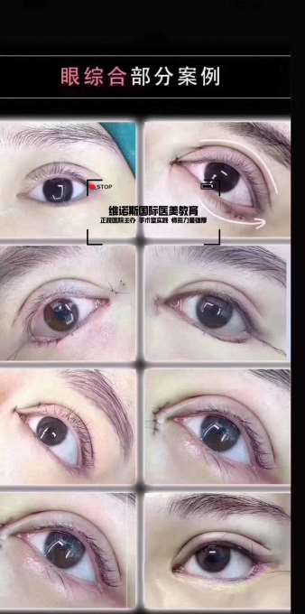 喀什面部徒手整形骨雕术一对一授课