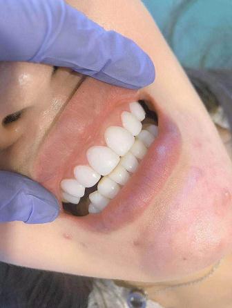 修复黄牙修复氟斑牙修复四环素牙2,如何修复牙缝过大1,如何修复瓜子牙