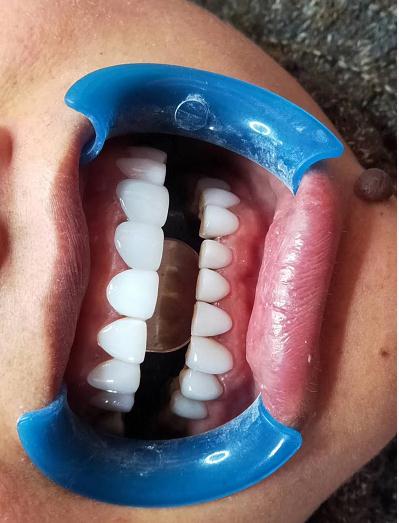 修复黄牙修复氟斑牙修复四环素牙2,如何修复牙缝过大1,如何修复瓜子牙